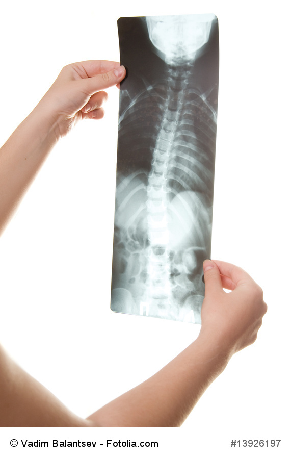 What is Scoliosis? Spinal Disorder Spine & Scoliosis Specialists